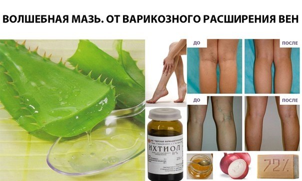 Варикоз Мазь Народная