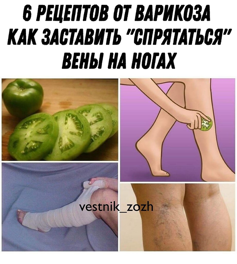 Вены На Ногах Зеленые