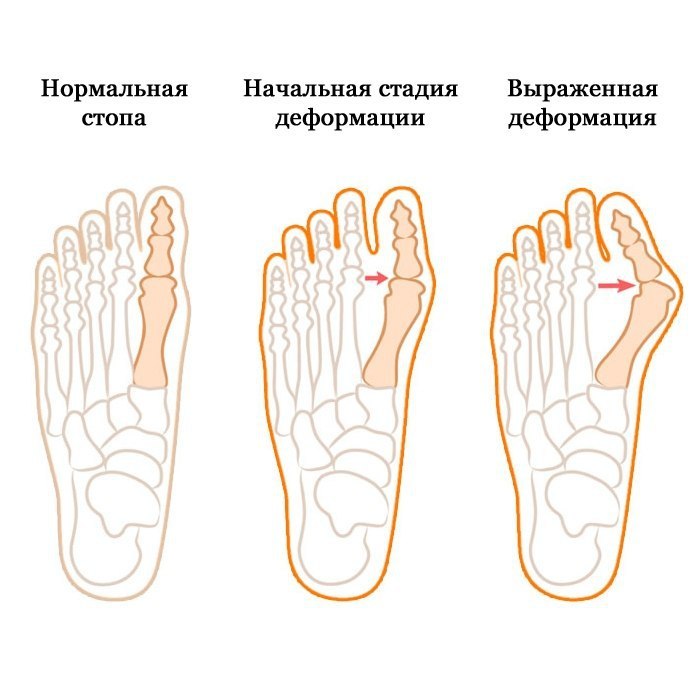 Деформация пальцев стопы мкб. Вальгус деформация большого пальца стопы. Вальгудеформация 1 пальца. Степени вальгусной деформации 1 пальца. Что такое вальгусная деформация 1 пальца на ноге.