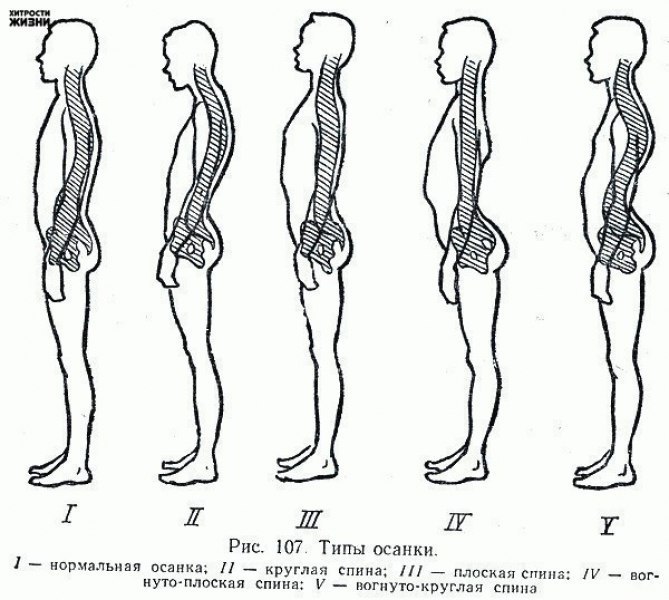 Плоская спина рисунок