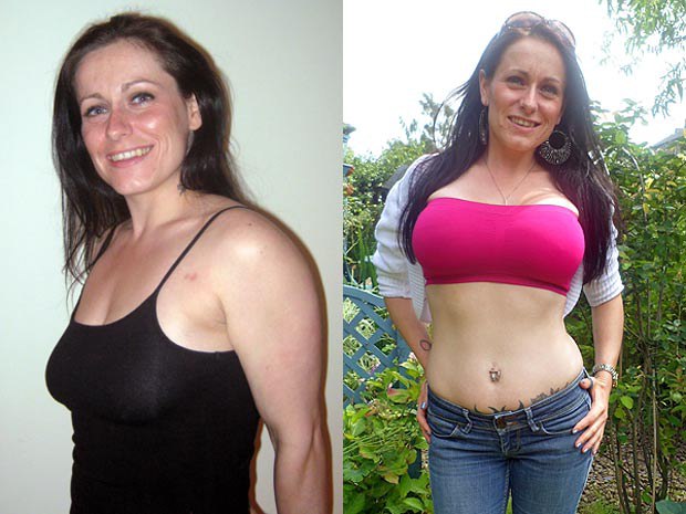 Увеличение груди фото до и после