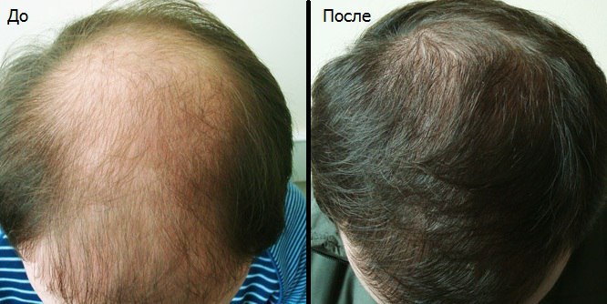 Поможет ли мужчине мезотерапия вернуть волосы на голове