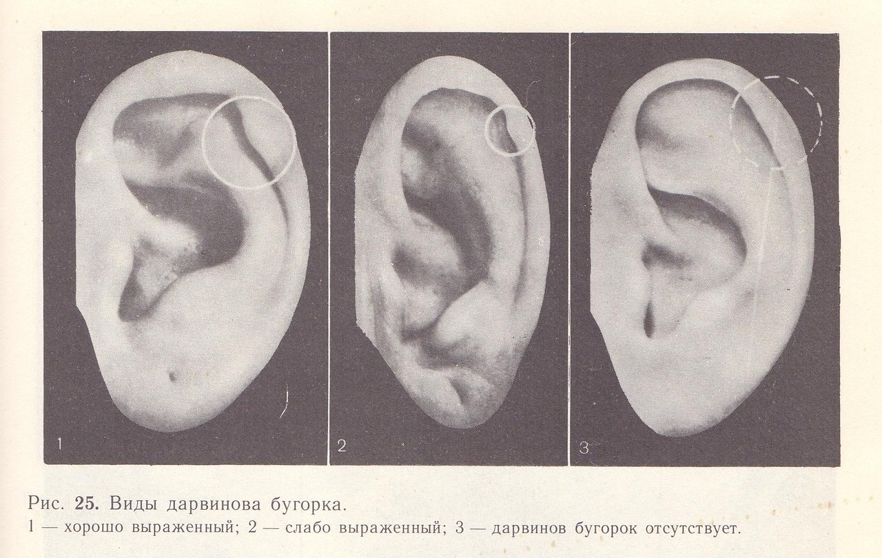 Бугорок дарвина на ухе фото