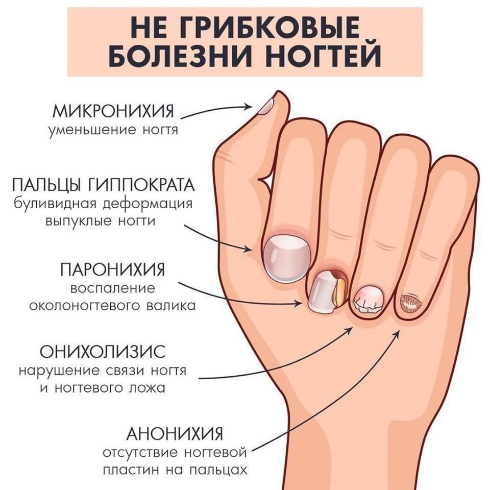 Заболевания по виду ногтей