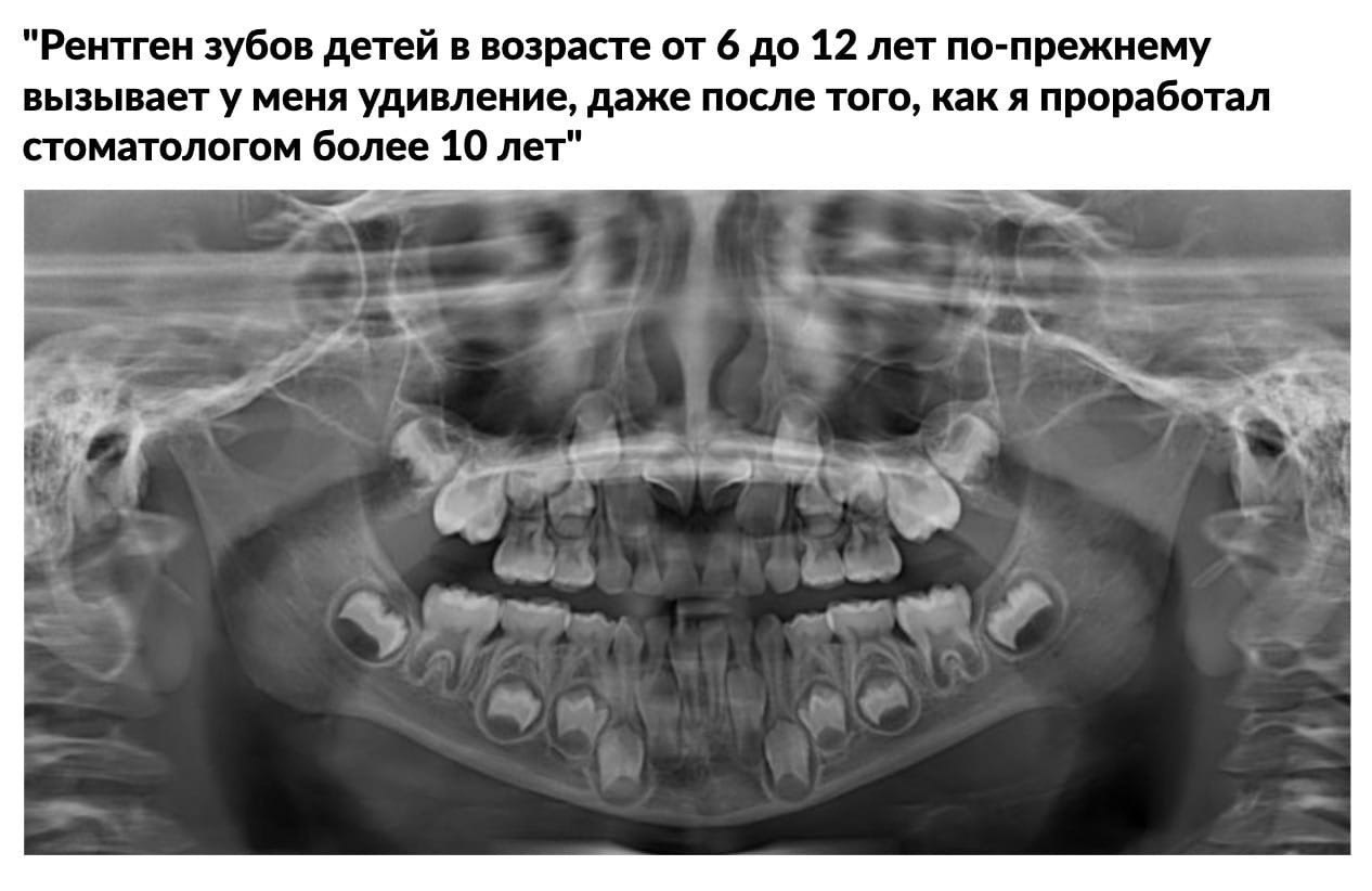 Рентген ребенку можно. Рентгеновский снимок зубов ребенка. Рентген челюсти младенца. Рентген челюсти грудничка.