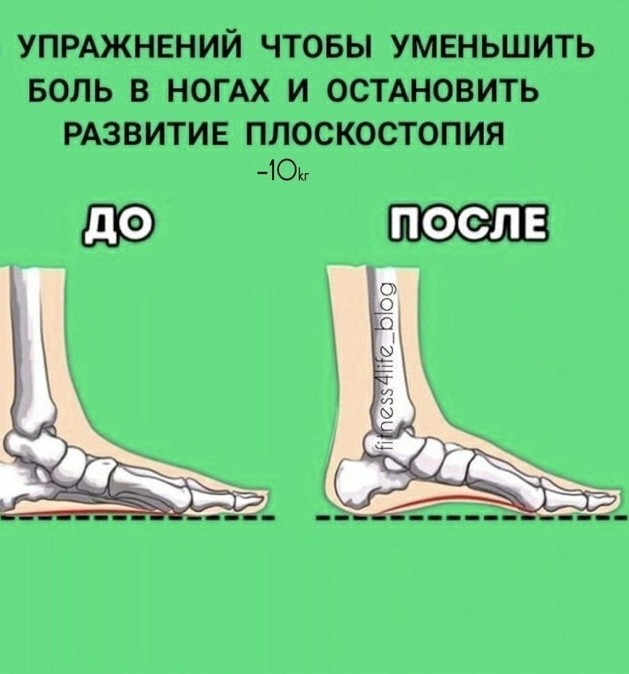 Боли в ногах при плоскостопии