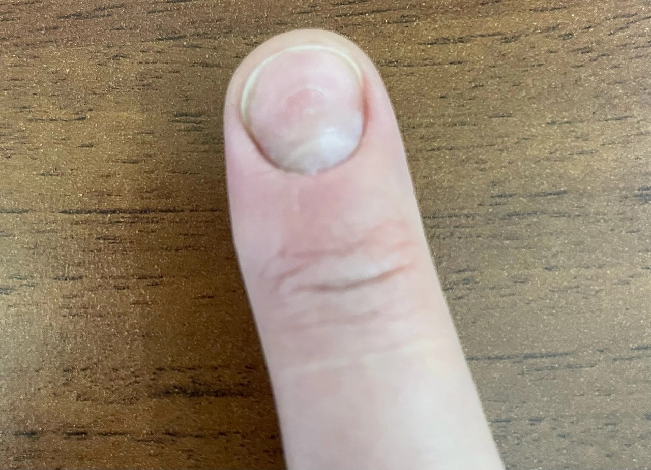 Палец без ногтевой пластины