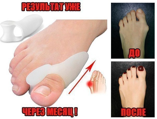 Valgus Plus -    .        1 ! ...