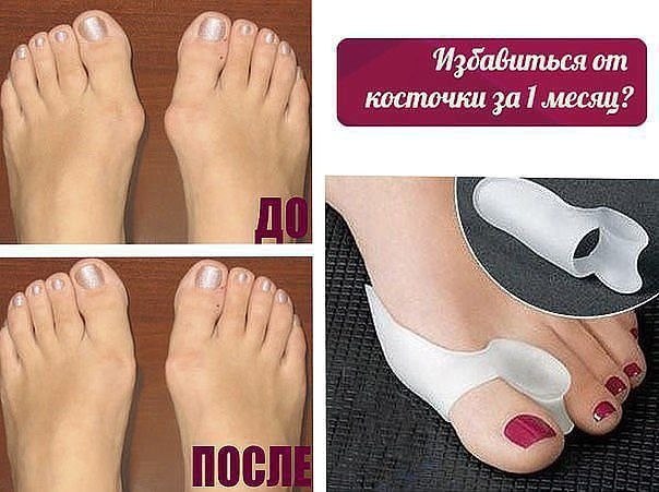    VALGUS PRO     .3  : ...