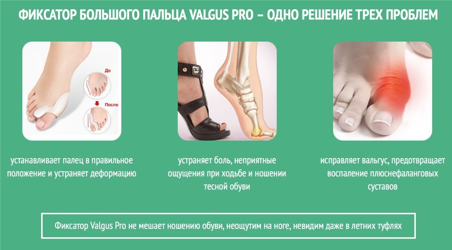 Фиксаторы вальгус про. Фиксатор "valgus Pro" (вальгус про). Обувь при вальгусной деформации большого пальца у женщин. Вальгус большого пальца на ноге. Болит большой палец на ноге.