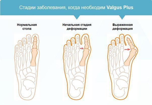 Valgus Plus     .        1 ... - 6