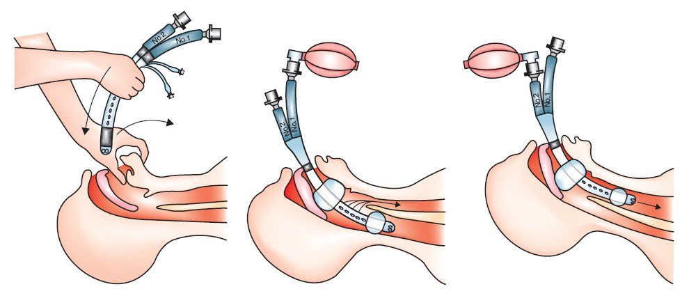Вставили трубку. Интубация трахеи методика выполнения. Интубация трахеи как проводится.