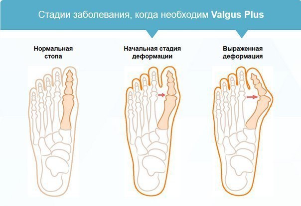 Valgus Plus -    .        1   ... - 5