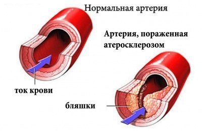 Как укрепить сосуды? Ослабление, истощение сосудов приводит к нарушению кровообращения и обмена ...