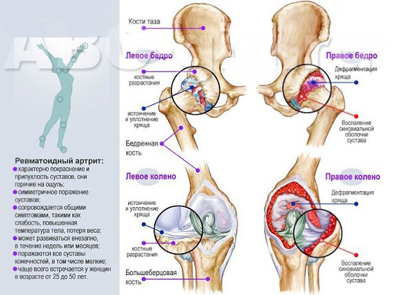 Таблетки от артрита остеоартроза. Препараты при артрите и артрозе. Лекарство для суставов хондропротекторы в таблетках. Разрушение хрящевой ткани коленного сустава. Артроз и артрит чем отличаются.