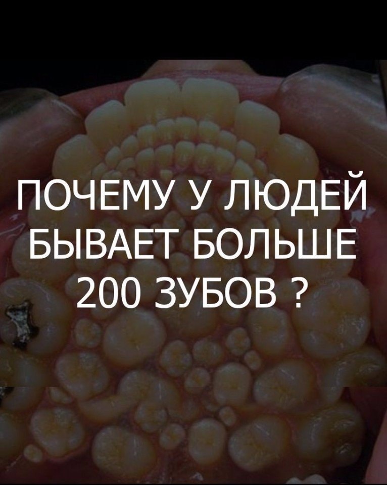 Почему растет второй. Человек у которого много зубов. Много зубов во рту болезнь. Несколько рядов зубов у человека.