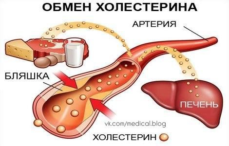 СНИЖЕНИЕ ХОЛЕСТЕРИНА НАРОДНЫМИ СРЕДСТВАМИ. Каких-то симптомов, говорящих о том, что у вас повышенный ...