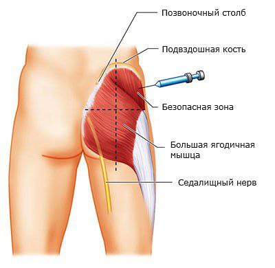 Мастерство внутримышечного укола: от плеча до ноги