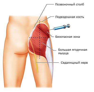 Делаем уколы правильно