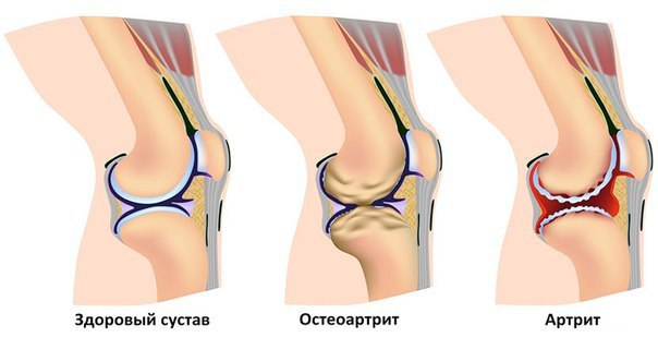 Хруст в суставах и его основной источник! Несмотря на то, что выше были озвучены слова «не впадать в ...