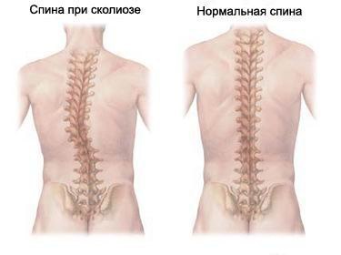 КАК ТРЕНИРОВАТЬСЯ ПРИ СКОЛИОЗЕ.Решила уделить внимание такой проблеме, которая очень широко ...