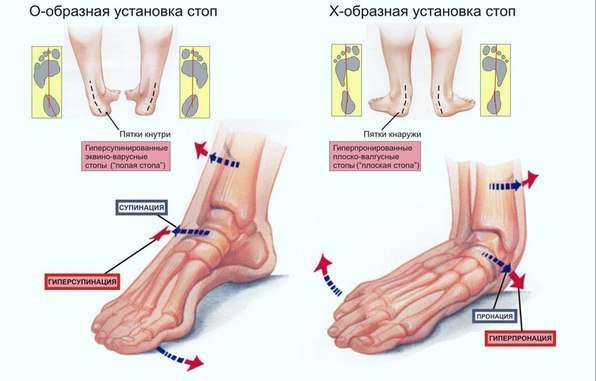 КОМПЛЕКС УПРАЖНЕНИЙ для ЛЕЧЕНИЯ ПЛОСКОСТОПИЯ. Несмотря на свою кажущуюся безобидность, плоскостопие ...