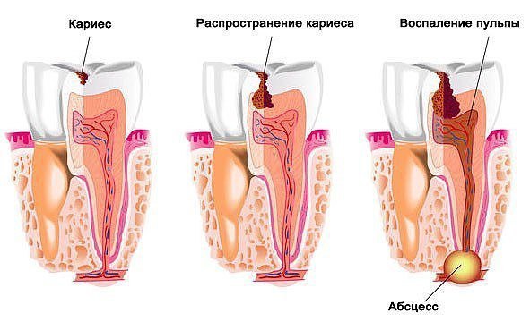Профилактика кариеса – как остановить и предотвратить кариес зубов.Профилактика кариеса – это самый ...