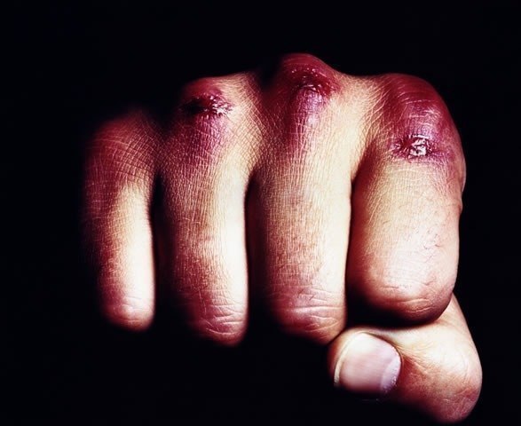 Разбитые костяшки на пальцах: симптомы, диагностика, лечение