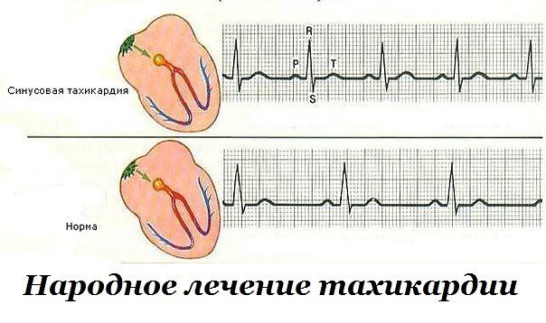 Народное лечение тахикардии | Всё о здоровье | Фотострана | Пост ...
