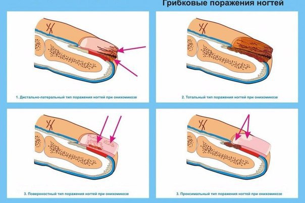 Лечение грибка ногтей йодом: отзывы пациентов