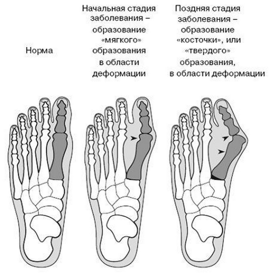 Как лечить народными средствами шишки на ноге возле большого пальца - VALGO