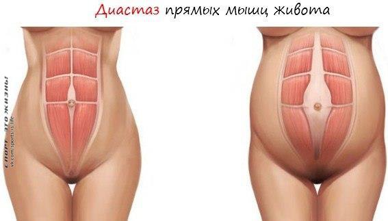Диастаз прямых мышц живота после родов. Кто виноват и что делать? Рождение ребенка – это одна из ...