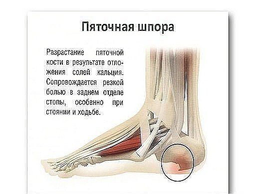 Пяточная шпора: 17 эффективных рецептов народной медицины.Пяточные шпоры - костные разрастания в ...