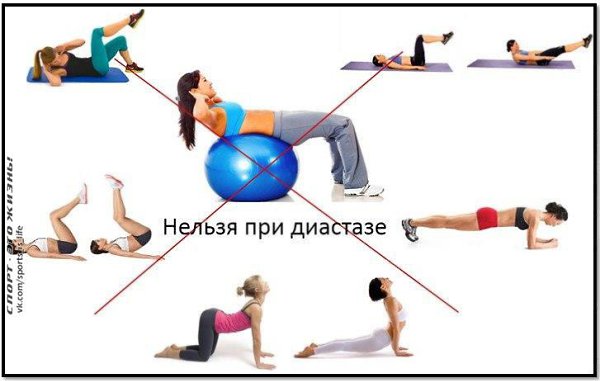 Диастаз прямых мышц живота после родов. Кто виноват и что делать? Рождение ребенка – это одна из ... - 3