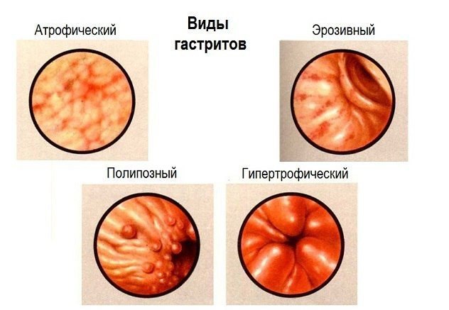 Эрозивный гастрит: лечение народными средствами