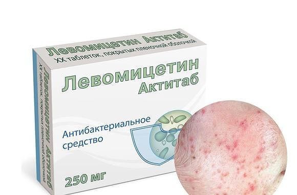 Средство от прыщей.. Страдаю, как и многие, проблемой прыщей. И недавно открыла для себя очень ...