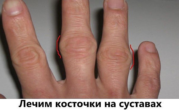 КОСТОЧКИ НА СУСТАВАХ. ПОЛЕЗНЫЕ СОВЕТЫ ИЗ БАБУШКИНОЙ ШКАТУЛКИ* Лечим косточки на суставах Зрелище — ...