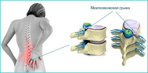 ПОЯСНИЧНАЯ ГРЫЖА ЛЕЧИТСЯ НАРОДНЫМИ СПОСОБАМИ. Поясничная грыжа – это болезнь серьезная! Поясничная ...