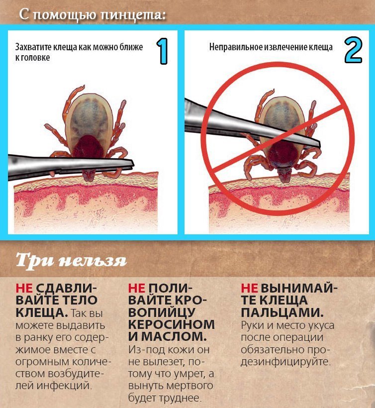 Правильное извлечение клеща. Извлечение клеща пинцетом.