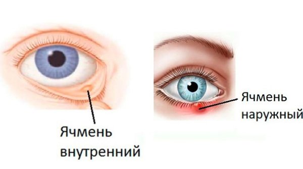 ГЛАЗНОЙ ЯЧМЕНЬ: КАК БЫСТРО ВЫЛЕЧИТЬ ДОМА.Что такое ячмень? Если объяснять простым языком – это ...