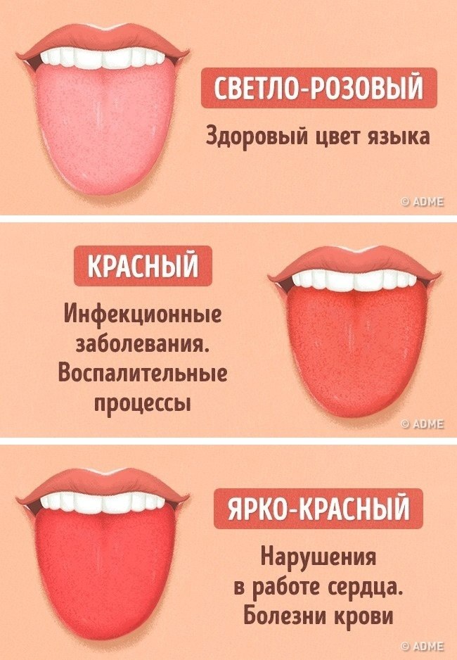 Как распознать болезни по языку: 10 симптомов, которые нельзя игнорировать