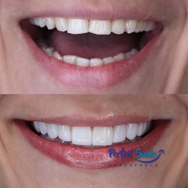     Perfect Smile Veneers!      . ... - 2