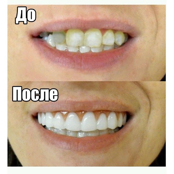 Мечтаете о Голливудской улыбке? Теперь это стало возможно,с иновационной накладкой Perfect smile ... - 2