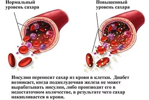 КАК ПРИВЕСТИ УРОВЕНЬ САХАРА В НОРМУ.Что предпринять на ранней стадии недуга? На начальной стадии ...