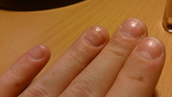 #Истории@modnailru.Девочки,помогите Ногти не ровные, волнистые, бугорками Не желтеют, не болят ... - 3