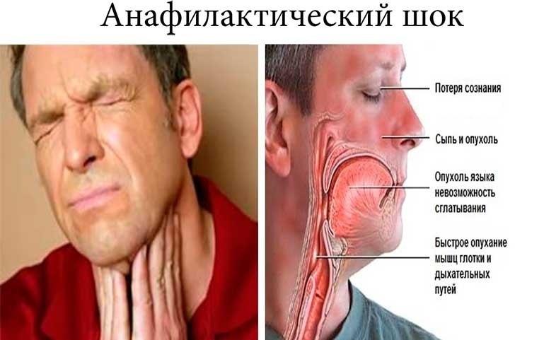 Неотложная помощь при анафилактическом шоке.Анафилактичeский шок – сaмaя быстрая и oпасная ...