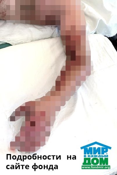 Кирилл Д., электротравма! Срочно нужна помощь нашему подопечному, Кириллу Д. из Ивановской области. ... - 2