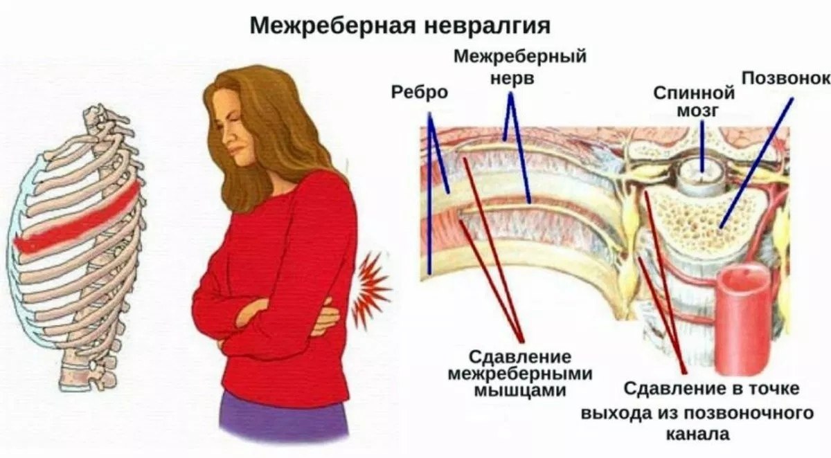 НЕВРАЛГИЯ, ПРИЧИНЫ, ПРИЗНАКИ,ЛЕЧЕНИЕ НАРОДНЫМИ СПОСОБАМИ. Народные методы лечения невралгии. ...