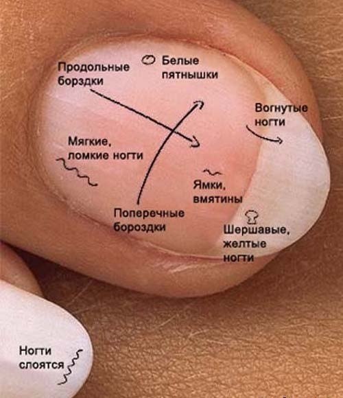 ДИАГНОЗ ПО НОГТЯМ.При хронических заболеваниях легких, сердца, печени, онкологических заболеваниях ...