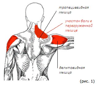 Боли дельтовидной мышцы плечевого сустава